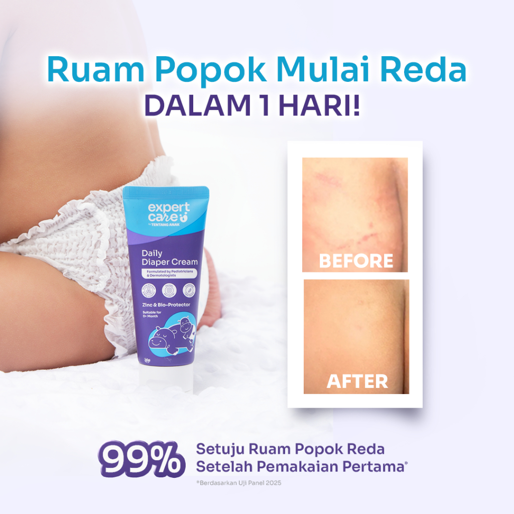 Expert Care Daily Diaper Cream | Diaper Rash Cream / Krim Kulit Ruam